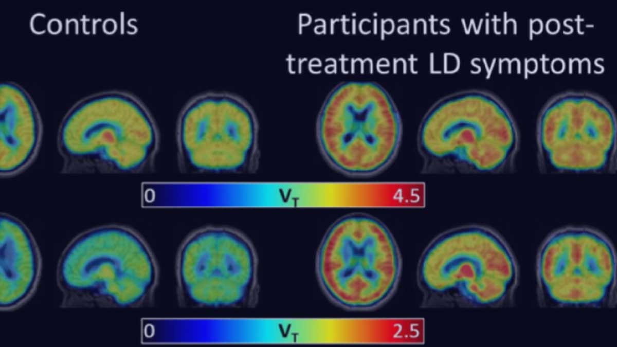 PET Imaging of Glial Activation in Patients with Post Treatment Lyme Disease