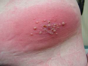 Vesciche di Lyme al centro dell'eruzione