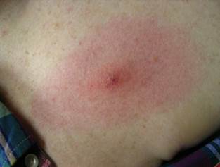 erythema migrans rash