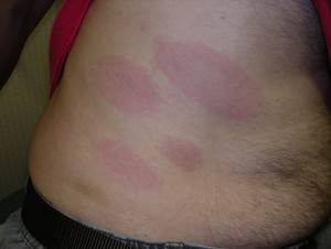 Il rash di Lyme si diffonde sulla pelle