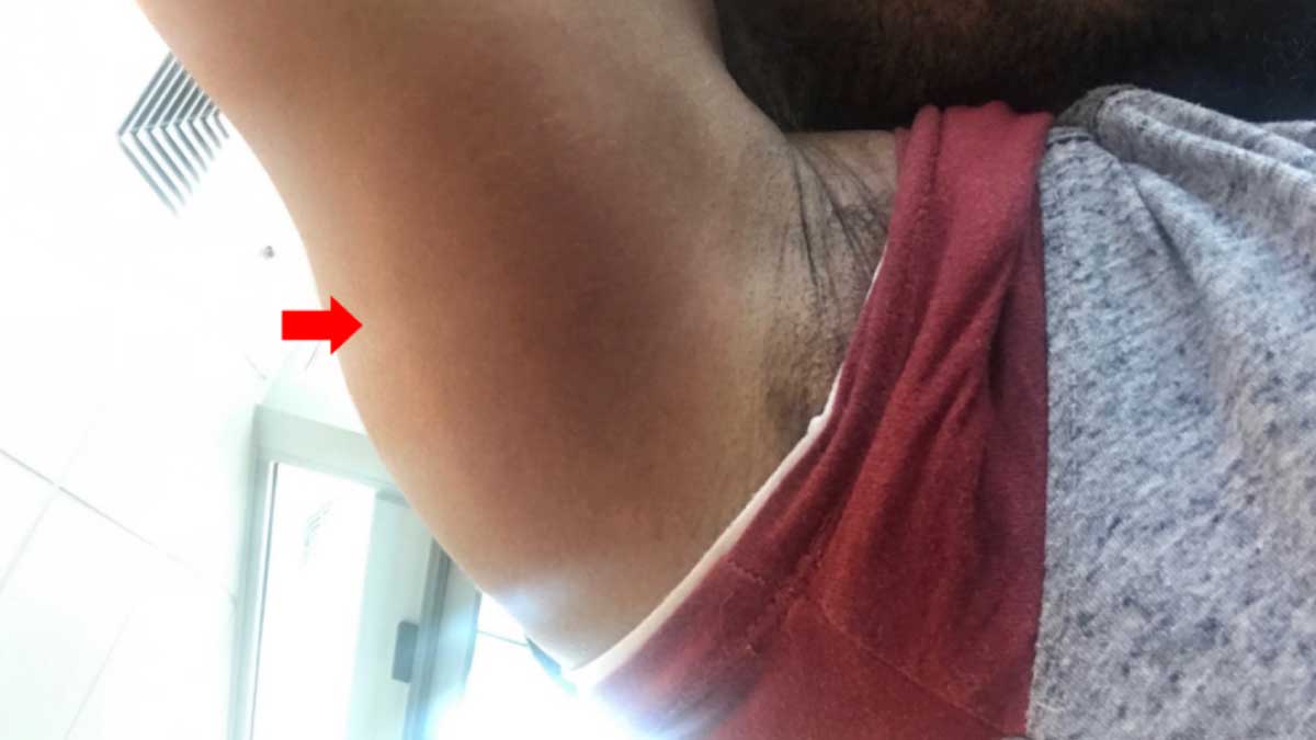 Lyme Rash Near Armpit on African-American Man