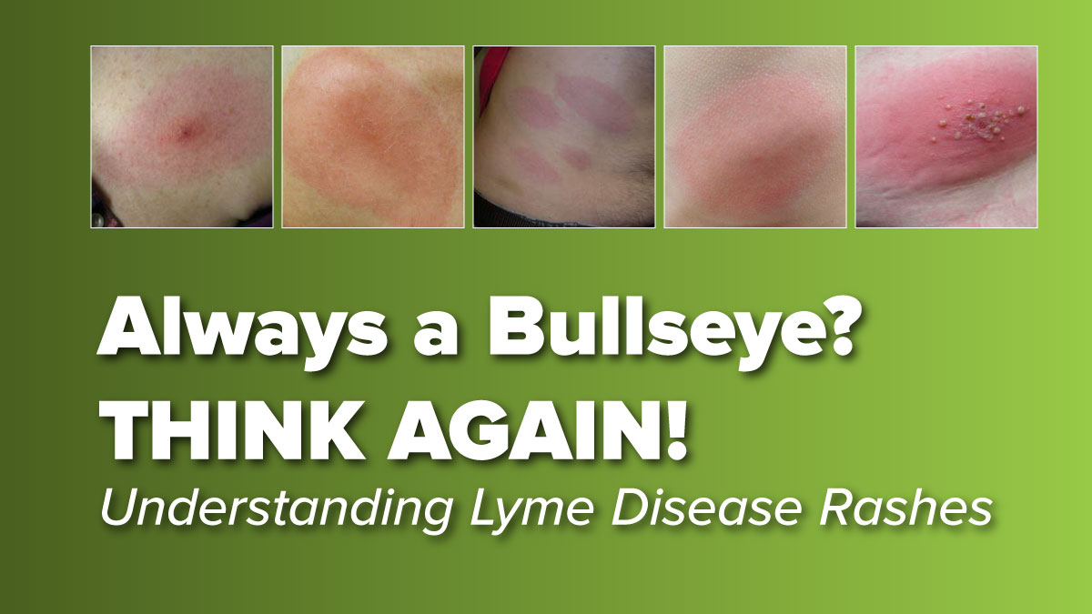 Think the Lyme Disease Rash is Always a Bullseye? THINK AGAIN!