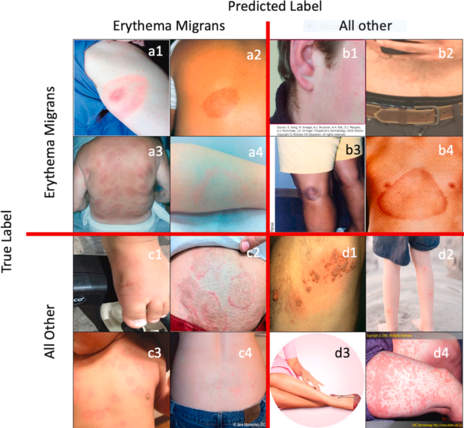 Digital photos of erythema migrans (EM) Lyme disease rashes compared to other clinically relevant rashes