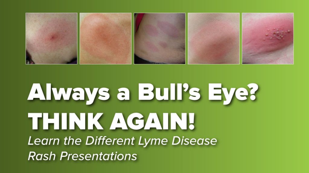 Think the Lyme Disease Rash is Always a Bullseye? THINK AGAIN! Johns