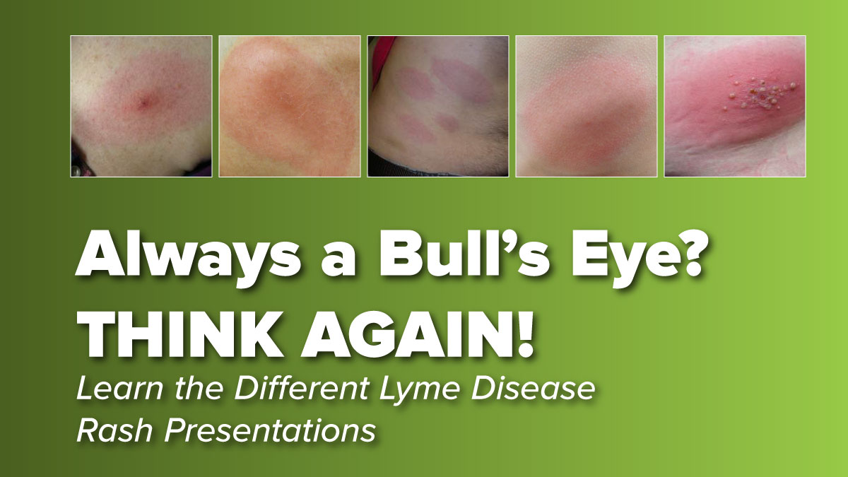 Would you recognize these Lyme disease rashes?