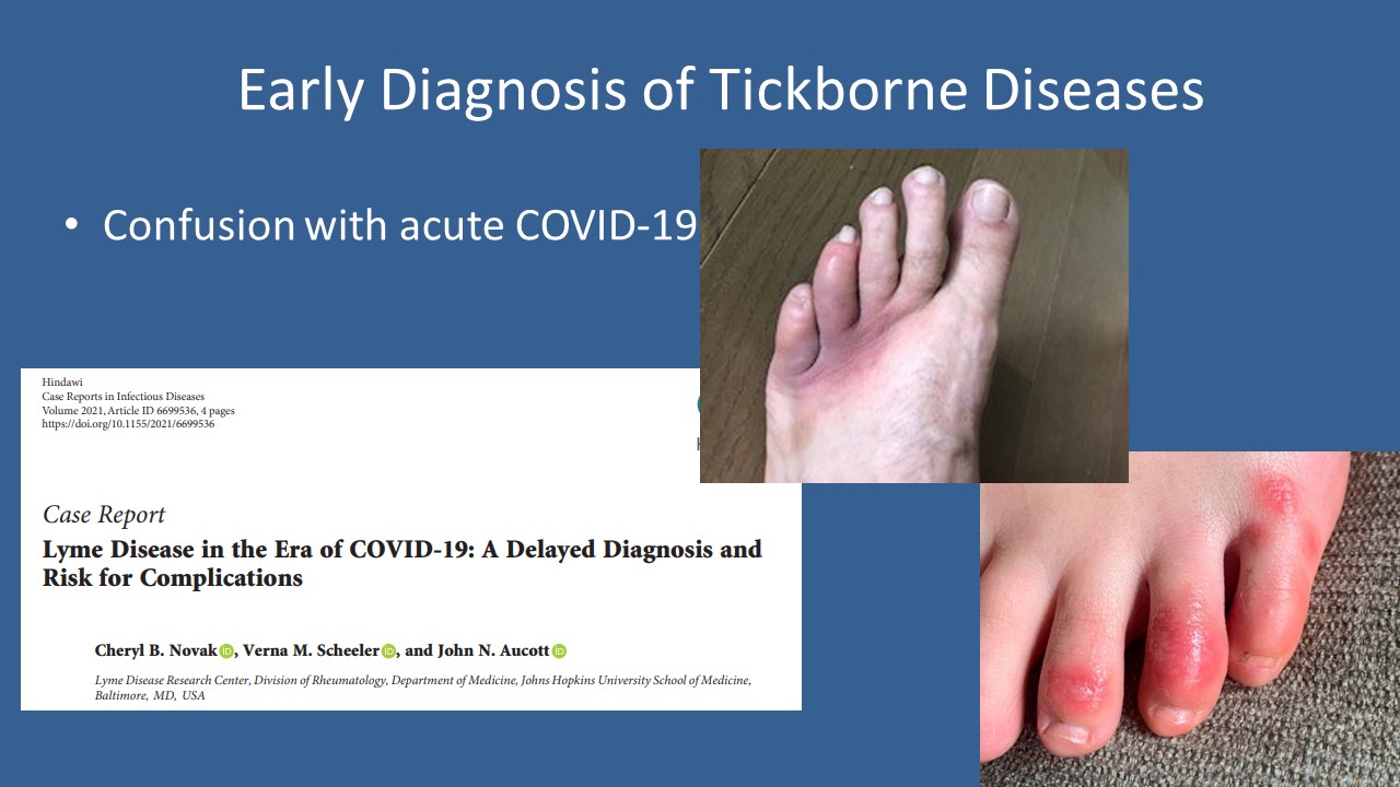 How to Distinguish the Symptoms of Acute Lyme Disease and Acute COVID-19