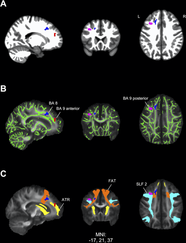 lyme brain fog treatment burbur