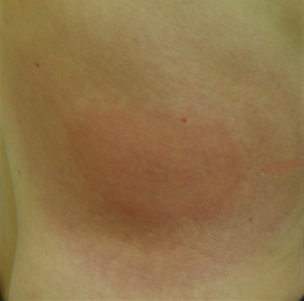 Lyme Disease Prevention Tips & What To Do After a Tick Bite : Johns ...