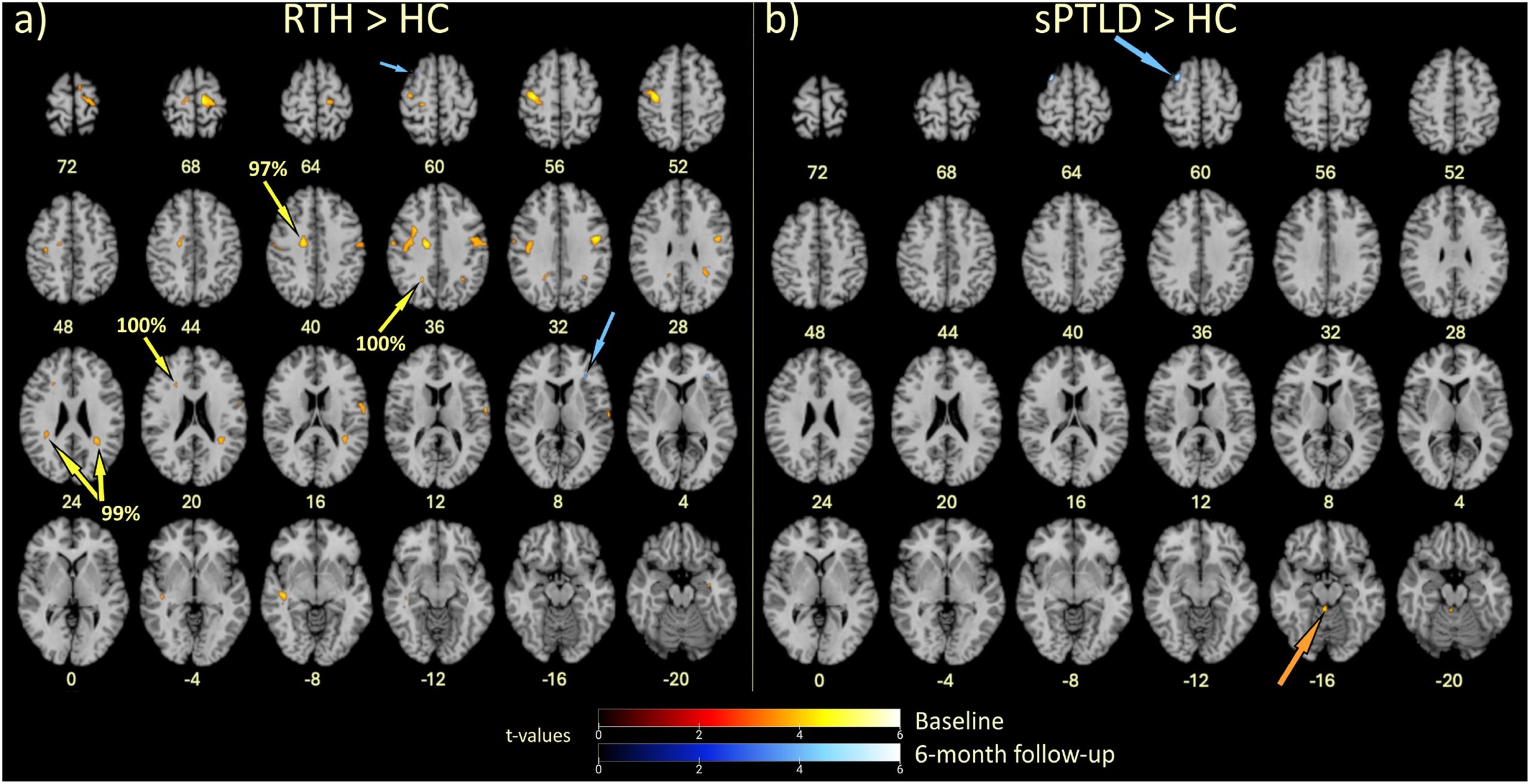 Early Brain Response Linked to Recovery from Lyme Disease